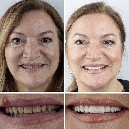 ⏰ KLENIMOR Natural Smile Upgrade