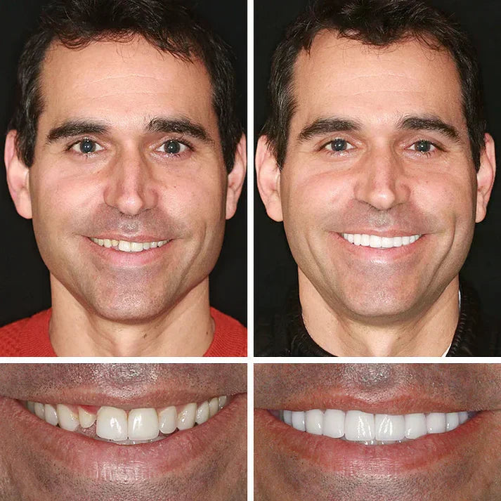 ⏰ KLENIMOR Natural Smile Upgrade