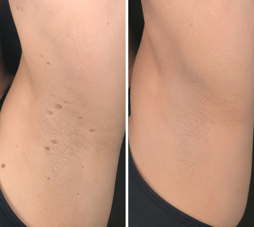 2-in-1 Microneedle & Hydrocolloid Patch 🌿 Invisible Face & Body Patches for Raised Moles, Acne, Flat Warts & Skin Tags - Helps Improve the Appearance of Wrinkles, Scars & Blemishes